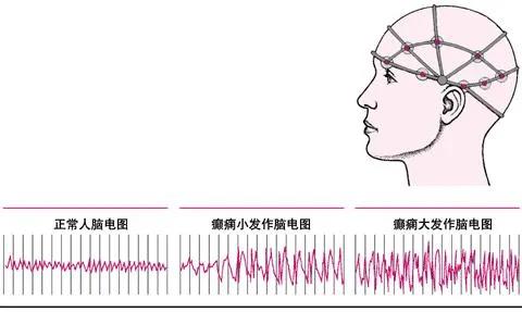 【健康科普】腦電圖是檢查什麼的?有沒有輻射