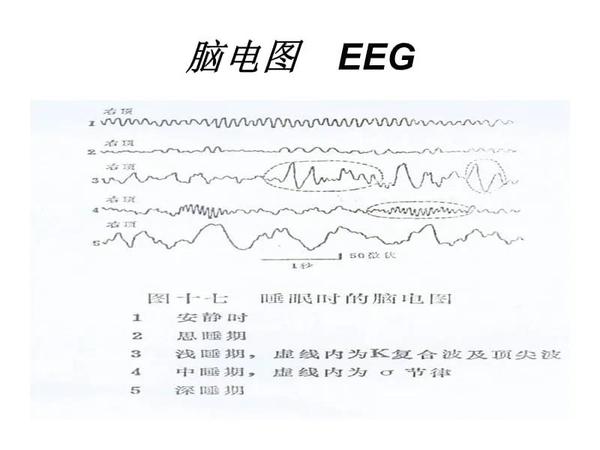 【健康科普】脑电图是检查什么的?有没有辐射
